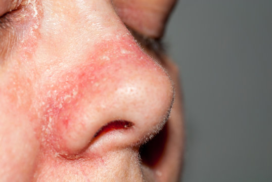 Psoriasis an der nase