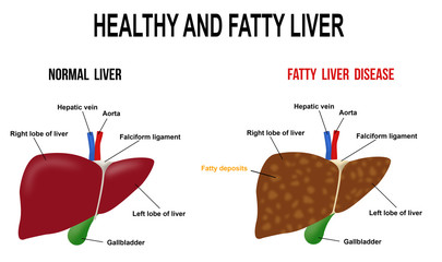 Healthy and fatty liver - obrazy, fototapety, plakaty