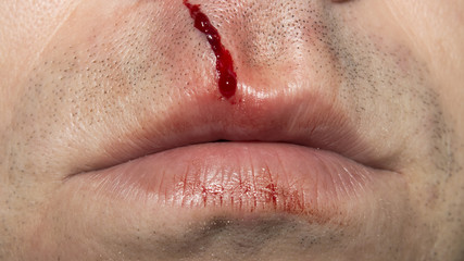 Naklejka premium Dissection of the upper lip.My lip is bloody.The wound of a man's lip.