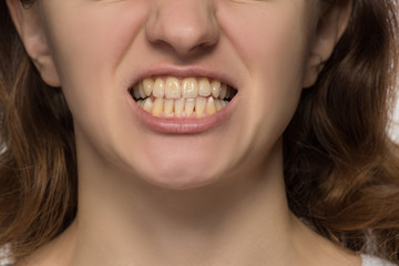 Yellow is not even and crooked teeth of a young woman