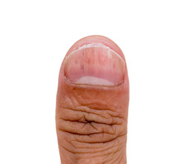 Nails having fungus disease