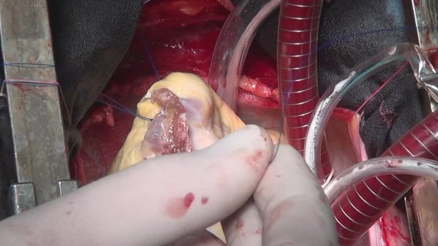 Surgeon sews up heart during operation on live organ of person in clinic. Process of struggle for life of patient. Unique macro video in hospital.