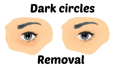 Dark circles under eyes to remove