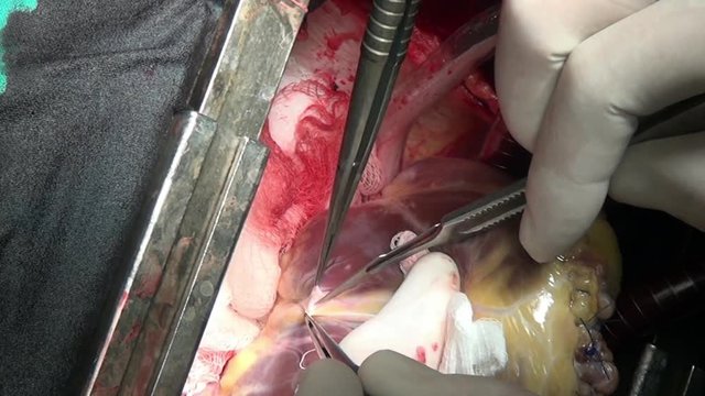 Heart surgery unique macro video close up in clinic. Struggle for life. Operation on live organ of patient in hospital.