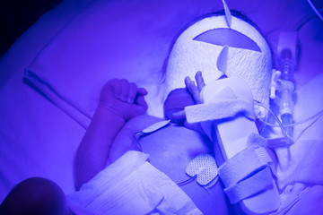 Premature baby recieving UV treatment for jaundice