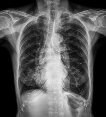 Normal chest X-ray of old patient . You can seen calcification at rib , trachea , bronchus . Front...