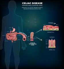 Celiac disease affected small intestine villi. Damaged cells by body's reaction to gluten. Intestinal villi do not absorb nutrients because of reduced surface area. Healthy villi and unhealthy villi.