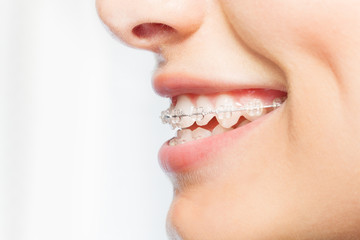 Side view picture of woman smile with clear braces