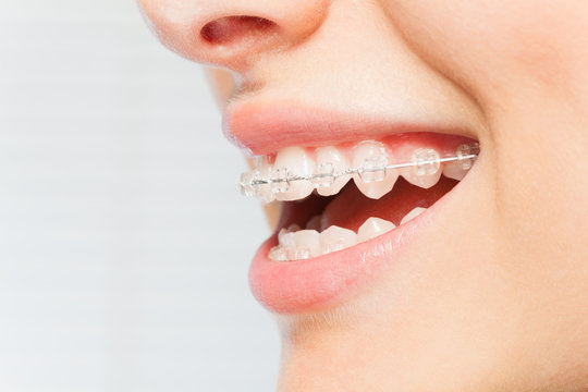 Woman's Smile With Clear Dental Braces On Teeth