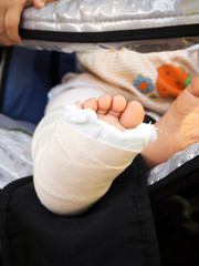 Closeup splint on baby girl right leg. Sitting in baba buggy. Child accident and broken bone.