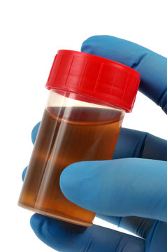 Flacon d'urine tenu avec une main gant&eacute;e 