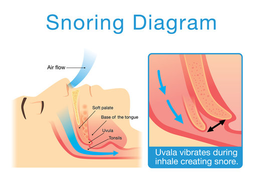 Anatomy Of Human Upper Airway While Sleeping With Snoring. Illustration About Medical Diagram.