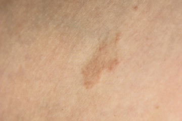 Naklejka premium Pityriasis rosea three weeks after the appearance of the first focus on the skin of a young woman. A pink lichen is an approximation on the thigh. Gibera Syndrome