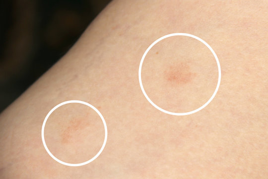Pityriasis rosea three weeks after the appearance of the first focus on the skin of a young woman. A pink lichen is an approximation on the thigh. Gibera Syndrome
