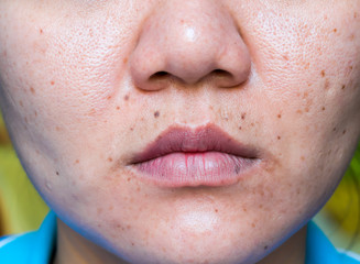 Woman 's problematic skin , acne scars ,oily skin and pore, dark spots and blackhead and whitehead on the face.