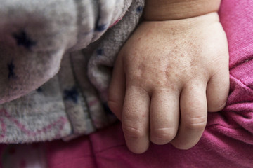 Scarlet fever. One children's hand with rash on white background.