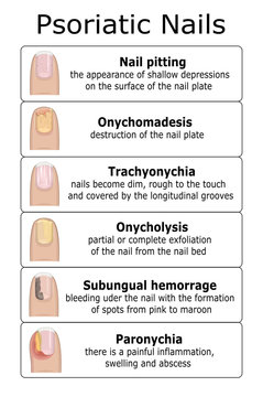 Ilustration of psoriatic nails