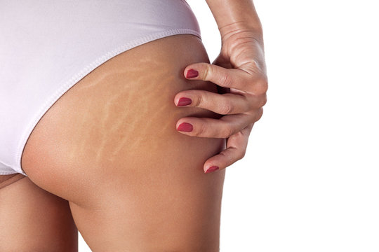 Woman buttocks with stretch marks and cellulite