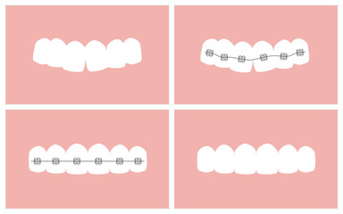 Vector image of the stages of orthodontic treatment (braces on teeth)