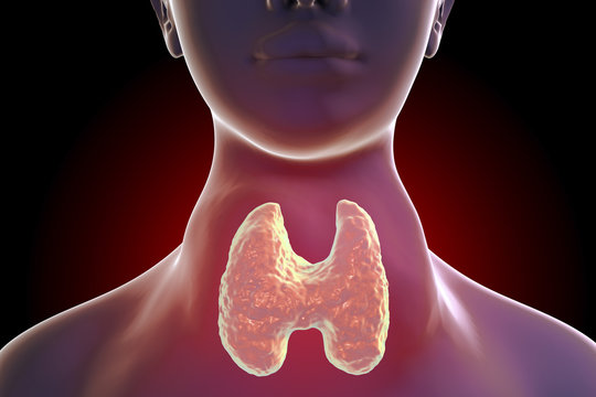 Toxic diffuse goiter, Flajani-Basedow-Graves' disease. 3D illustration showing enlarged thryoid gland in a female with hyperthyroidism