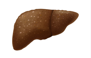 Human liver have scar tissue problem from drink alcohol too much. Illustration about Hepatitis and Cirrhosis symptom.