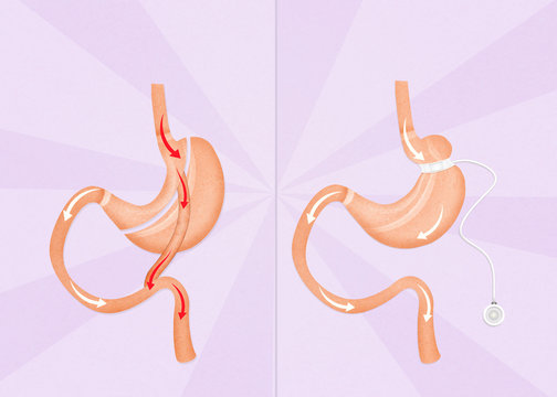 illustration of gastric bypass and gastric band surgery