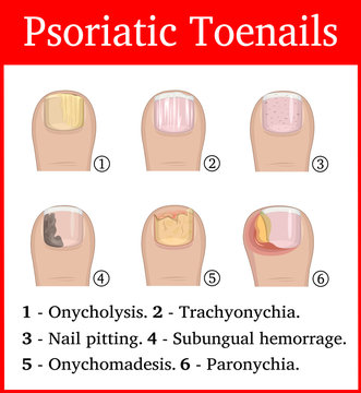 Illustration of Psoriatic toenails