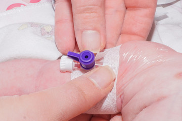 Intravenous catheterization of newborn baby in neonatal intensive care unit