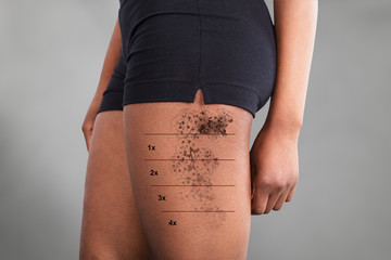 Laser Tattoo Removal On Woman's Thigh