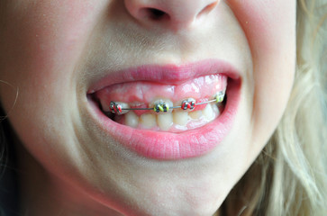 Dental brace children teeth
