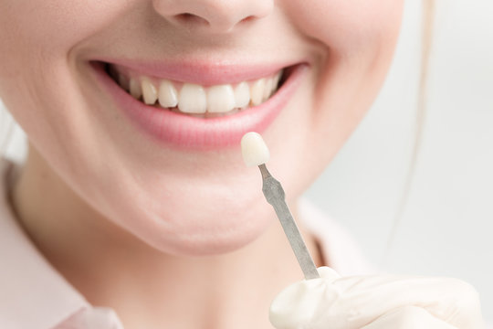 Zahnfarbprobe wird an den Mund einer jungen Frau angehalten