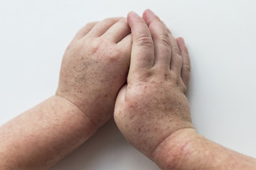 Scarlet fever. Two children's hands with rash on white background.