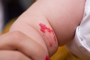 Capillary hemangioma red birthmark on the babys leg