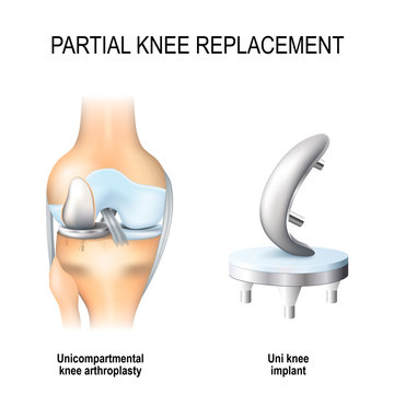 partial knee replacement.