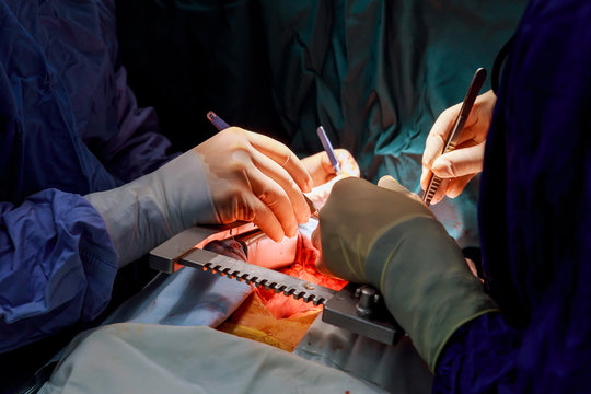 Surgeon during an operation on the open heart
