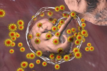 Perinatal transmission of HIV infection, conceptual image. 3D illustration showing AIDS viruses infecting embryo inside uterus