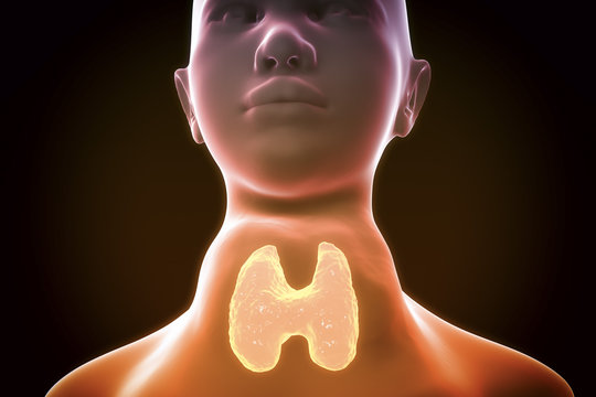Toxic diffuse goiter, Flajani-Basedow-Graves' disease. 3D illustration showing enlarged thryoid gland in a female with hyperthyroidism