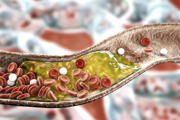 Cholesterol plaque in artery, 3D illustration. Concept for coronary artery disease