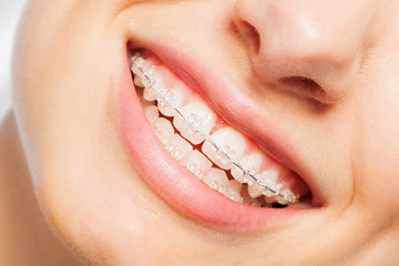 Happy smile of young woman with dental braces - obrazy, fototapety, plakaty