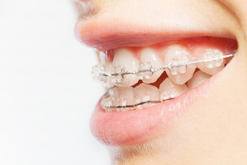 Side view picture of teeth with clear braces