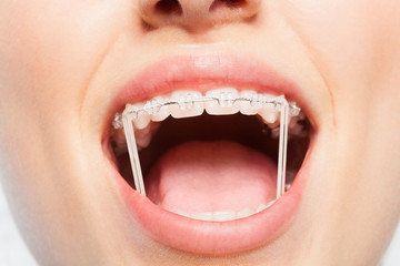 Woman mouth with orthodontic elastics on braces