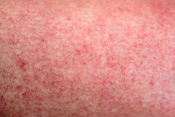 Skin with dengue fever red rashes - obrazy, fototapety, plakaty