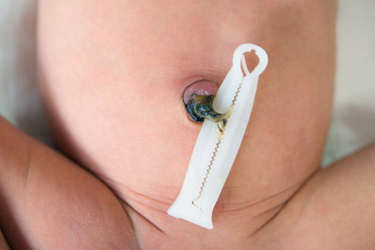 Umbilical cord with clamp of newborn