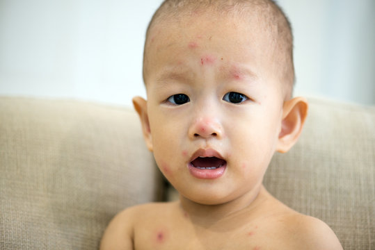 Asian baby boy with chicken pox