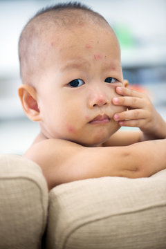 Baby boy with chicken pox at home