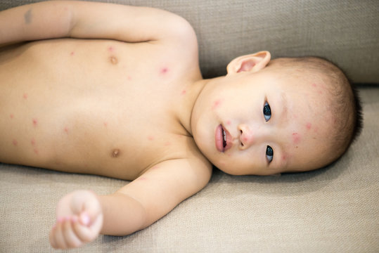 Baby boy with chicken pox lying on sofa