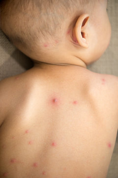 Baby back with chicken pox