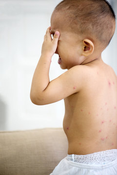 Baby boy with chicken pox crying
