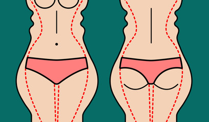 Liposuction of body