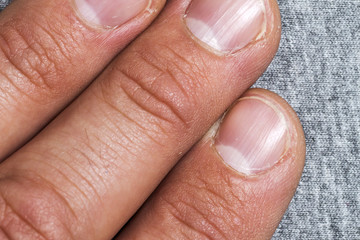 Mens fingers and nails in bad condition close up